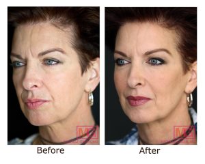 تغییرات چهره پس از ترک سیگار